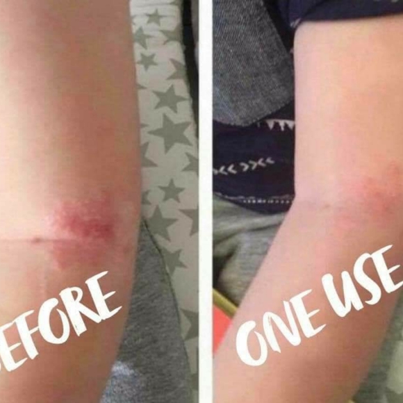 PREORDER ONLY ByeBye Stretch Marks,Mosquitos,Burns - Picture 14 of 16